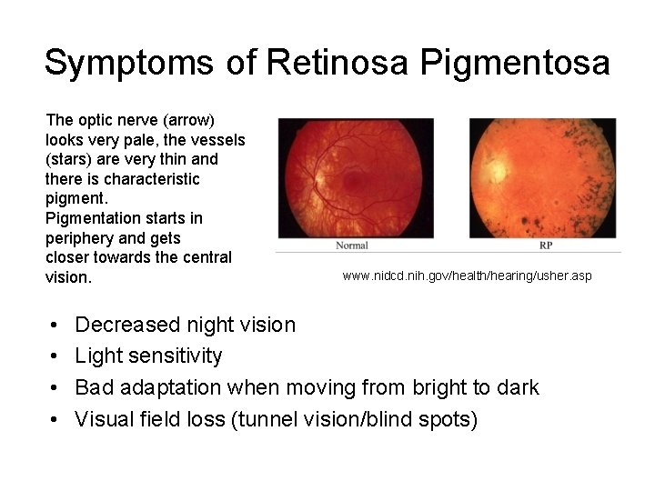 Symptoms of Retinosa Pigmentosa The optic nerve (arrow) looks very pale, the vessels (stars) Symptoms of Retinosa Pigmentosa The optic nerve (arrow) looks very pale, the vessels (stars)