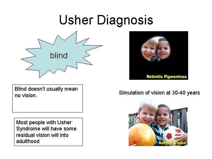 Usher Diagnosis blind Blind doesn’t usually mean no vision. Most people with Usher Syndrome Usher Diagnosis blind Blind doesn’t usually mean no vision. Most people with Usher Syndrome