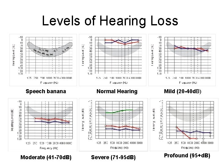 Levels of Hearing Loss Speech banana Moderate (41 -70 d. B) Normal Hearing Severe Levels of Hearing Loss Speech banana Moderate (41 -70 d. B) Normal Hearing Severe