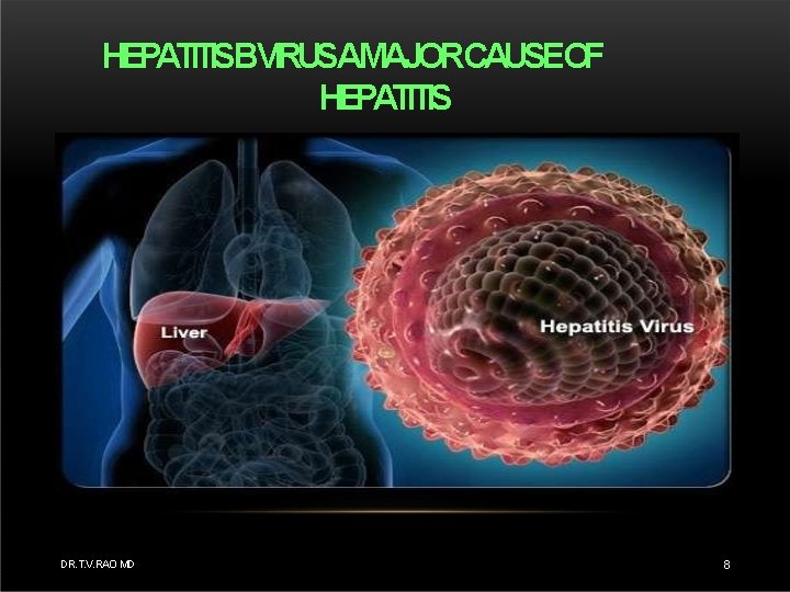 HEPATITISBVIRUSAMAJORCAUSEOF HEPATITIS DR. T. V. RAO MD 8 