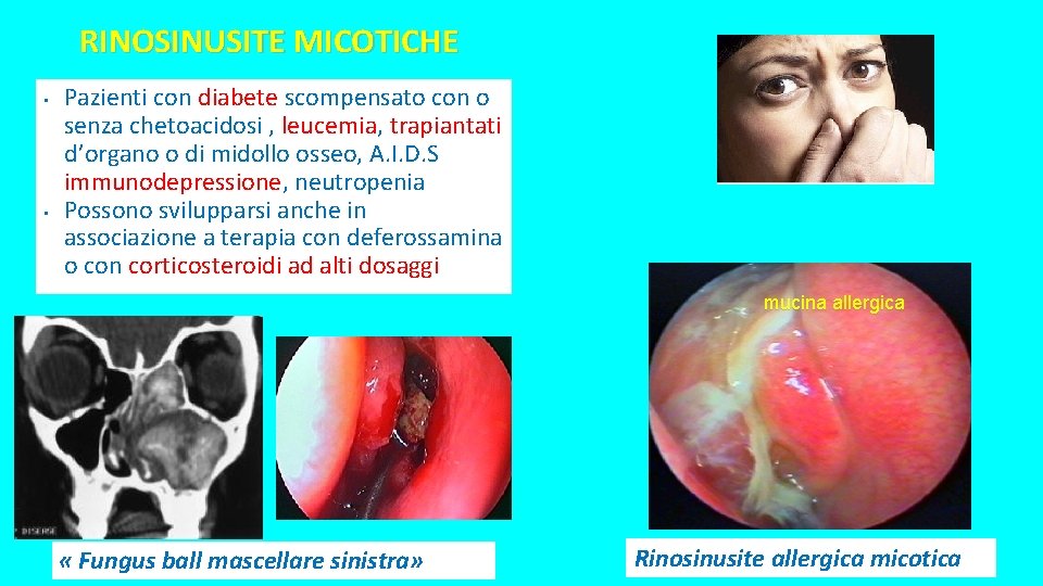 RINOSINUSITE MICOTICHE • • Pazienti con diabete scompensato con o senza chetoacidosi , leucemia, RINOSINUSITE MICOTICHE • • Pazienti con diabete scompensato con o senza chetoacidosi , leucemia,