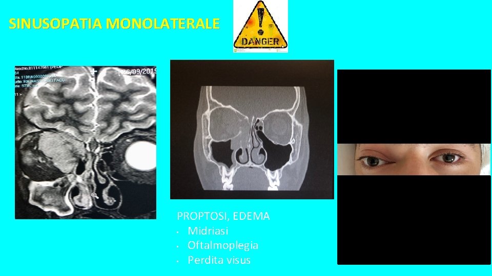 SINUSOPATIA MONOLATERALE PROPTOSI, EDEMA • Midriasi • Oftalmoplegia • Perdita visus SINUSOPATIA MONOLATERALE PROPTOSI, EDEMA • Midriasi • Oftalmoplegia • Perdita visus