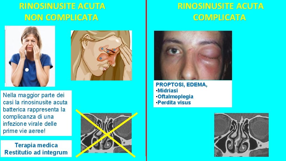 RINOSINUSITE ACUTA NON COMPLICATA Nella maggior parte dei casi la rinosinusite acuta batterica rappresenta RINOSINUSITE ACUTA NON COMPLICATA Nella maggior parte dei casi la rinosinusite acuta batterica rappresenta