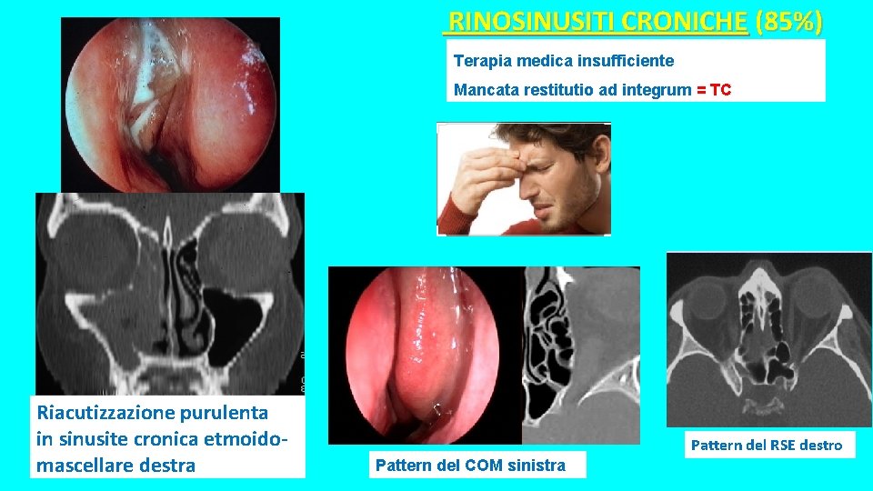 RINOSINUSITI CRONICHE (85%) Terapia medica insufficiente Mancata restitutio ad integrum = TC Riacutizzazione purulenta RINOSINUSITI CRONICHE (85%) Terapia medica insufficiente Mancata restitutio ad integrum = TC Riacutizzazione purulenta
