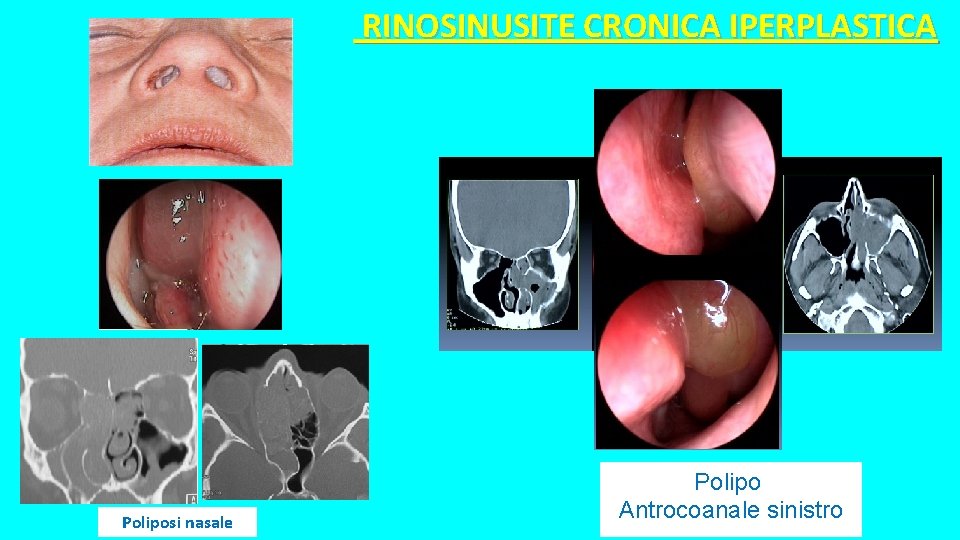 RINOSINUSITE CRONICA IPERPLASTICA Poliposi nasale Polipo Antrocoanale sinistro RINOSINUSITE CRONICA IPERPLASTICA Poliposi nasale Polipo Antrocoanale sinistro