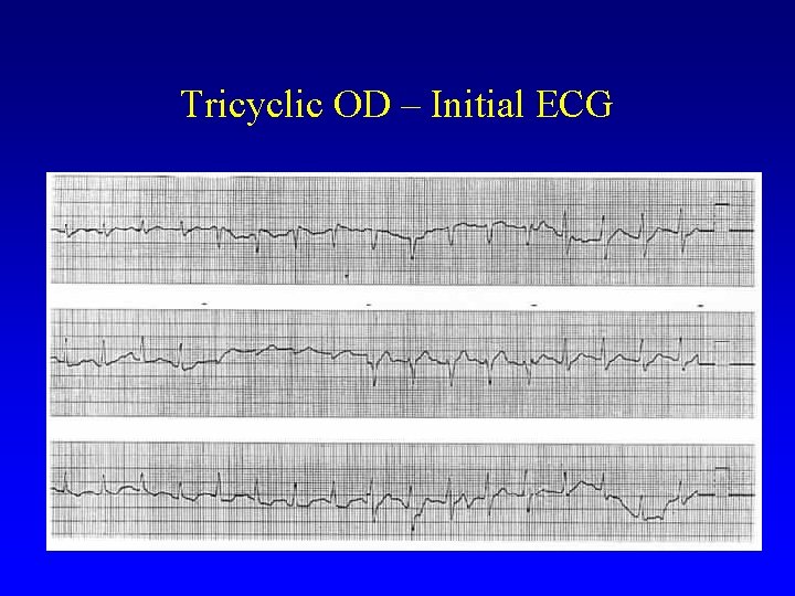 Tricyclic OD – Initial ECG 