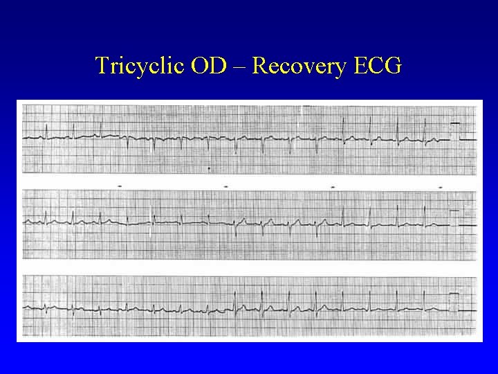 Tricyclic OD – Recovery ECG 