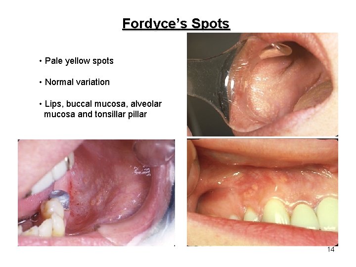 Fordyce’s Spots • Pale yellow spots • Normal variation • Lips, buccal mucosa, alveolar