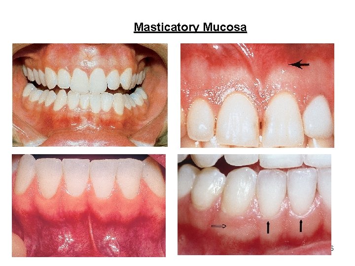 Masticatory Mucosa 6 