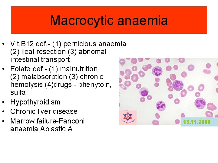 Macrocytic anaemia • Vit. B 12 def. - (1) pernicious anaemia (2) ileal resection Macrocytic anaemia • Vit. B 12 def. - (1) pernicious anaemia (2) ileal resection