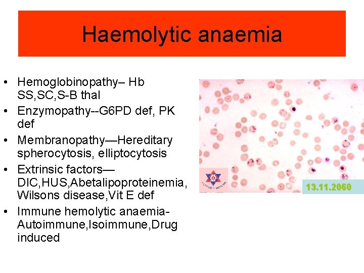 Haemolytic anaemia • Hemoglobinopathy– Hb SS, SC, S-B thal • Enzymopathy--G 6 PD def, Haemolytic anaemia • Hemoglobinopathy– Hb SS, SC, S-B thal • Enzymopathy--G 6 PD def,