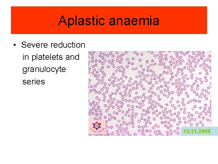 Aplastic anaemia • Severe reduction in platelets and granulocyte series 13. 11. 2060 Aplastic anaemia • Severe reduction in platelets and granulocyte series 13. 11. 2060