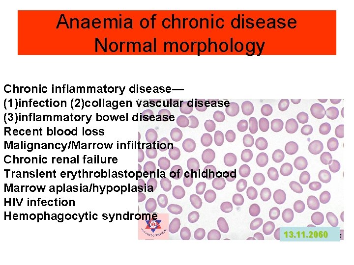 Anaemia of chronic disease Normal morphology Chronic inflammatory disease— (1)infection (2)collagen vascular disease (3)inflammatory Anaemia of chronic disease Normal morphology Chronic inflammatory disease— (1)infection (2)collagen vascular disease (3)inflammatory