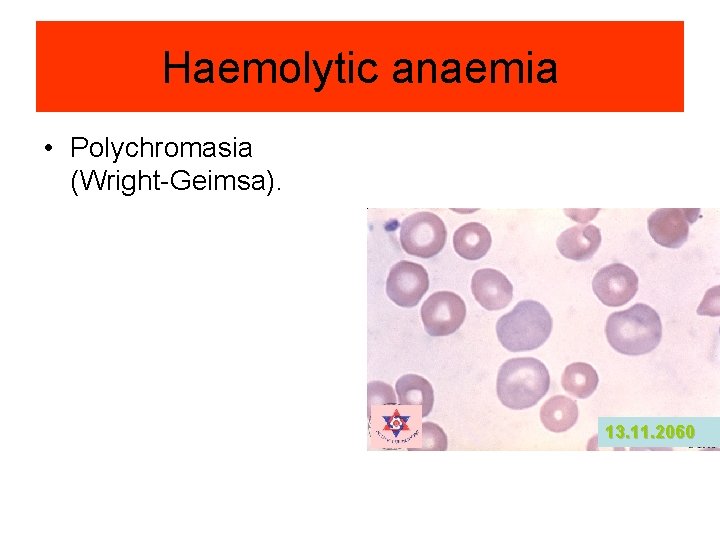 Haemolytic anaemia • Polychromasia (Wright-Geimsa). 13. 11. 2060 Haemolytic anaemia • Polychromasia (Wright-Geimsa). 13. 11. 2060