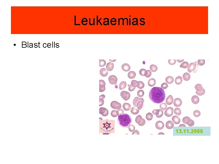 Leukaemias • Blast cells 13. 11. 2060 Leukaemias • Blast cells 13. 11. 2060