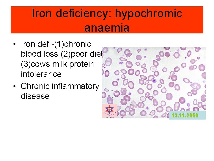 Iron deficiency: hypochromic anaemia • Iron def. -(1)chronic blood loss (2)poor diet (3)cows milk Iron deficiency: hypochromic anaemia • Iron def. -(1)chronic blood loss (2)poor diet (3)cows milk