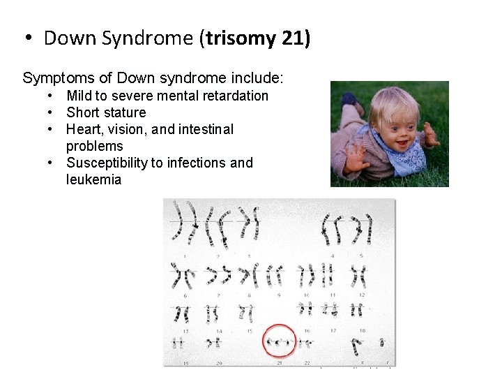 • Down Syndrome (trisomy 21) Symptoms of Down syndrome include: • Mild to • Down Syndrome (trisomy 21) Symptoms of Down syndrome include: • Mild to