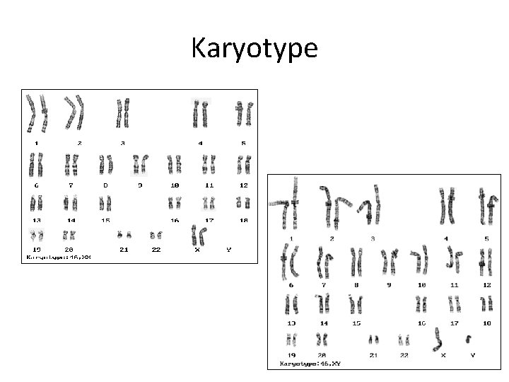 Karyotype Karyotype