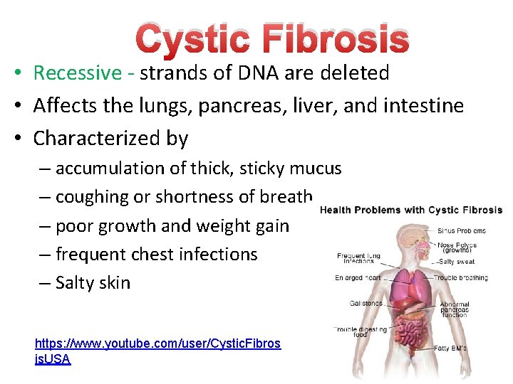 Cystic Fibrosis • Recessive - strands of DNA are deleted • Affects the lungs, Cystic Fibrosis • Recessive - strands of DNA are deleted • Affects the lungs,