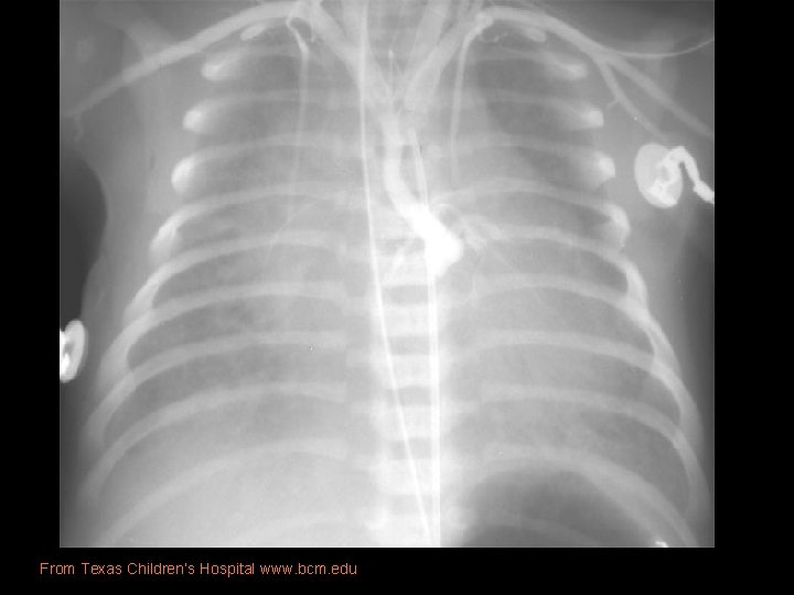 From Texas Children’s Hospital www. bcm. edu 