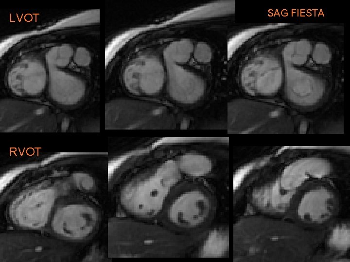 LVOT RVOT SAG FIESTA 
