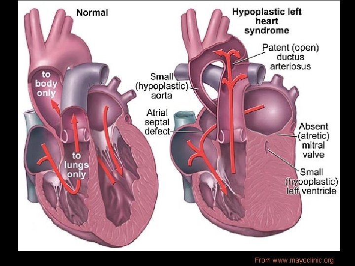 From www. mayoclinic. org 