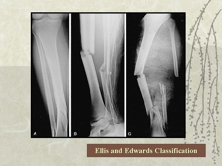 Ellis and Edwards Classification 