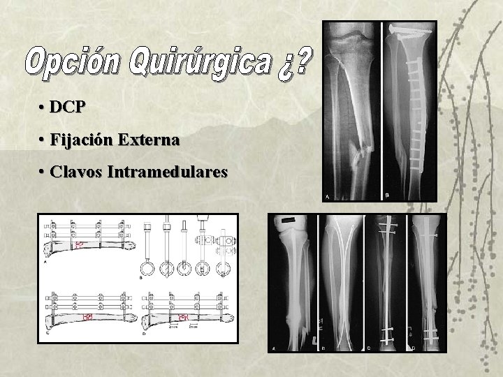 • DCP • Fijación Externa • Clavos Intramedulares 