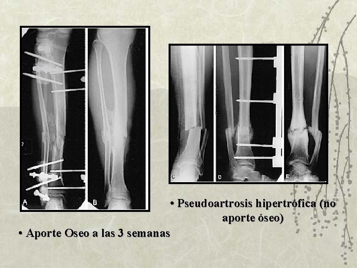  • Pseudoartrosis hipertrófica (no aporte óseo) • Aporte Oseo a las 3 semanas