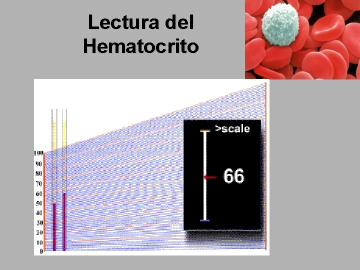 Lectura del Hematocrito 