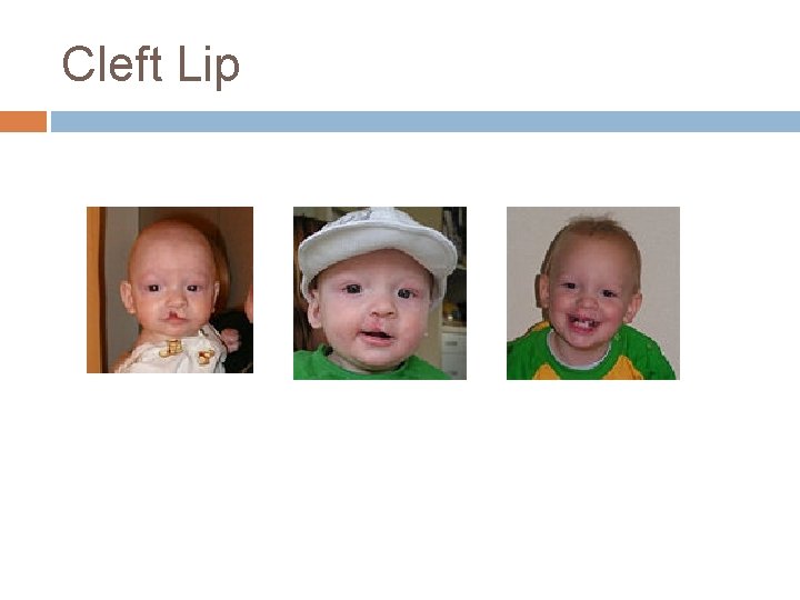 Cleft Lip Cleft Lip