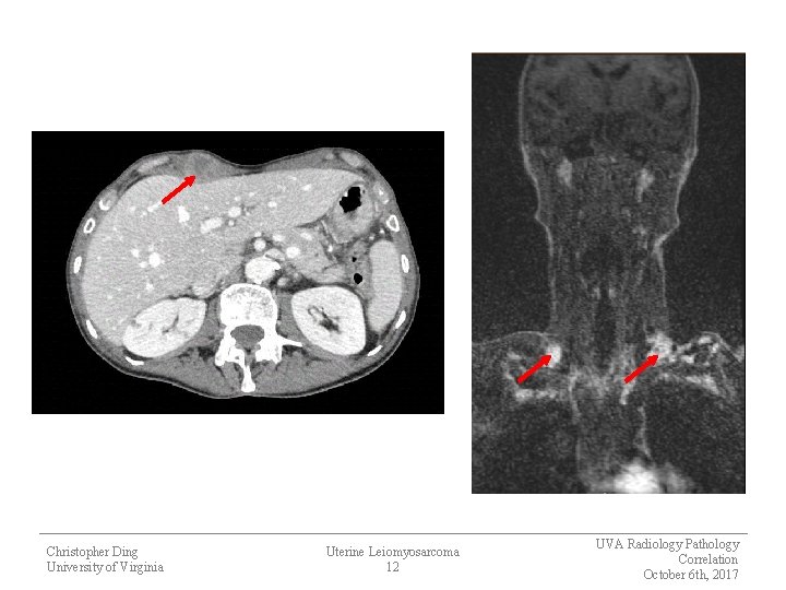 Christopher Ding University of Virginia Uterine Leiomyosarcoma 12 UVA Radiology Pathology Correlation October 6