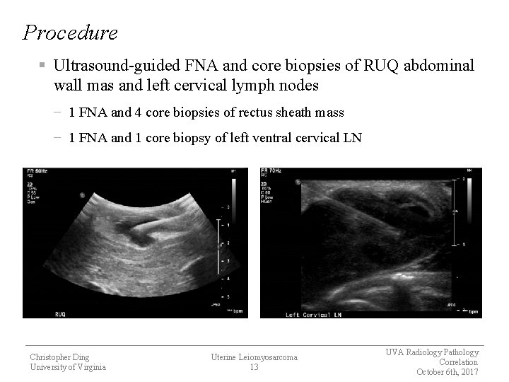 Procedure § Ultrasound-guided FNA and core biopsies of RUQ abdominal wall mas and left