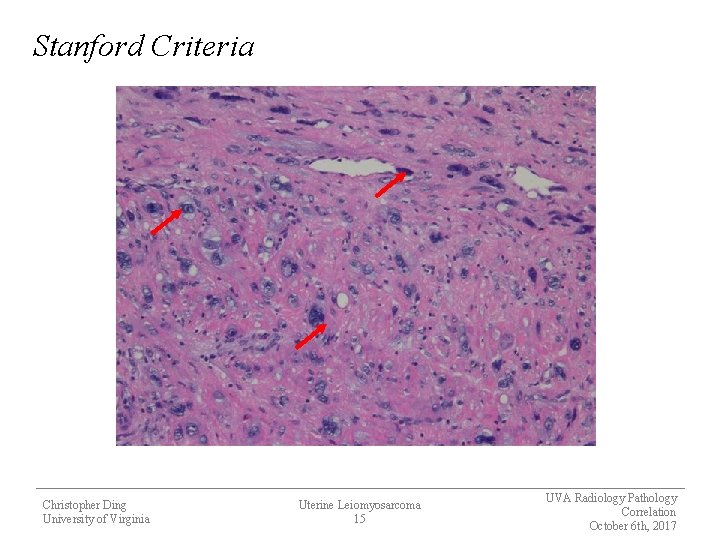 Stanford Criteria Christopher Ding University of Virginia Uterine Leiomyosarcoma 15 UVA Radiology Pathology Correlation