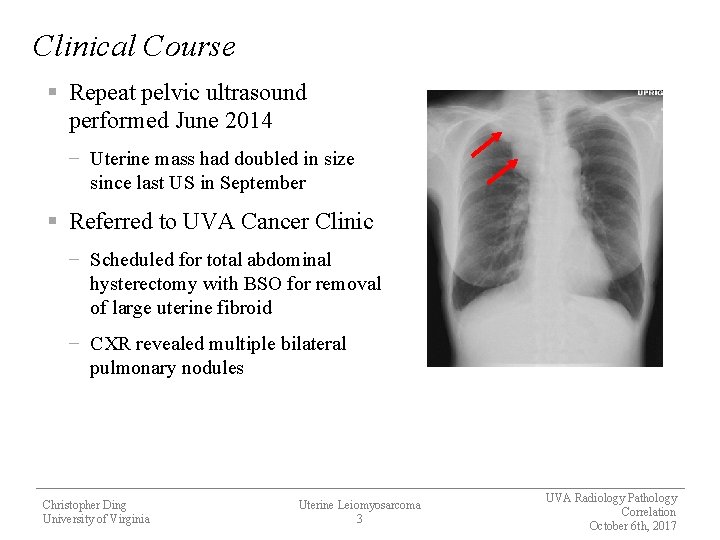 Clinical Course § Repeat pelvic ultrasound performed June 2014 − Uterine mass had doubled