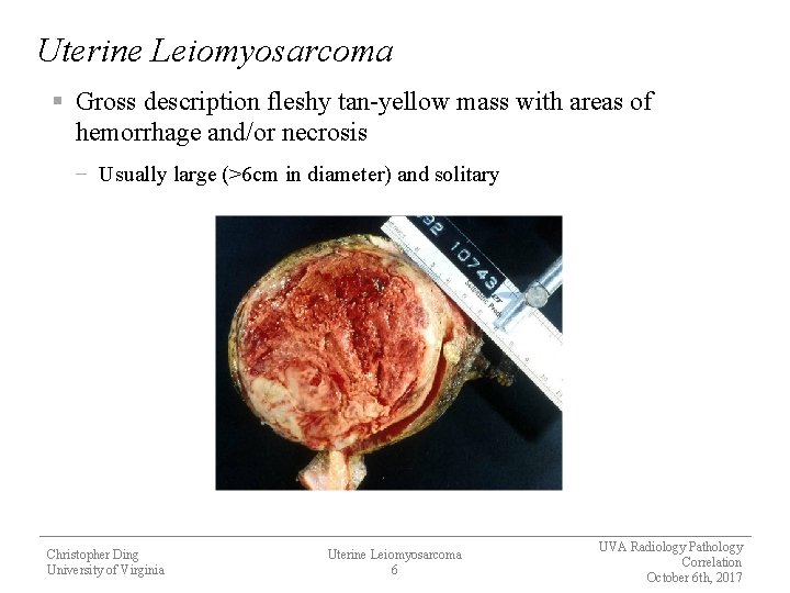 Uterine Leiomyosarcoma § Gross description fleshy tan-yellow mass with areas of hemorrhage and/or necrosis