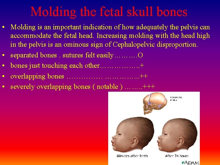 Molding the fetal skull bones • Molding is an important indication of how adequately