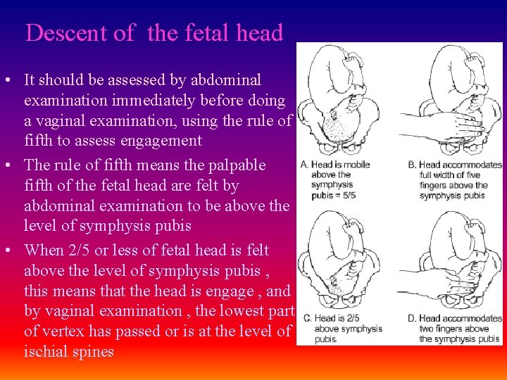 Descent of the fetal head • It should be assessed by abdominal examination immediately