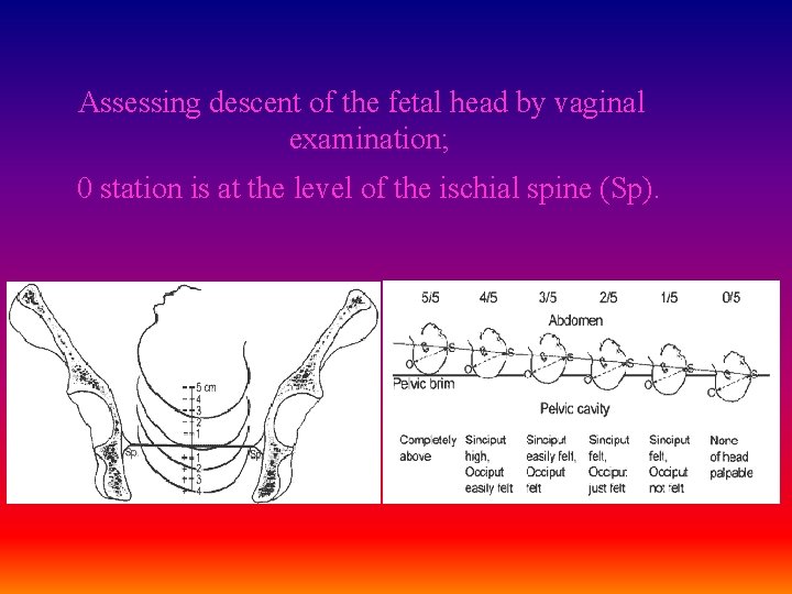 Assessing descent of the fetal head by vaginal examination; 0 station is at the