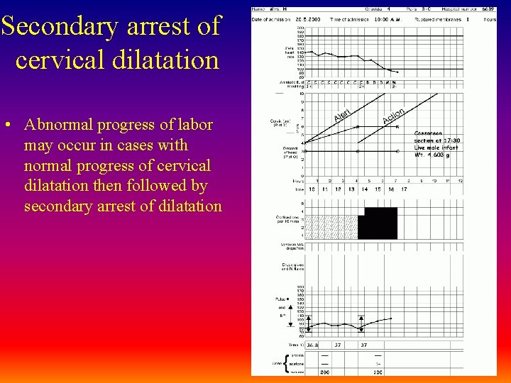 Secondary arrest of cervical dilatation • Abnormal progress of labor may occur in cases