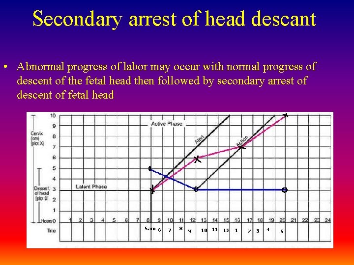Secondary arrest of head descant • Abnormal progress of labor may occur with normal