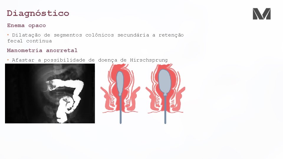 Diagnóstico Enema opaco • Dilatação de segmentos colônicos secundária a retenção fecal contínua Manometria
