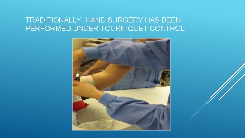 TRADITIONALLY, HAND SURGERY HAS BEEN PERFORMED UNDER TOURNIQUET CONTROL 