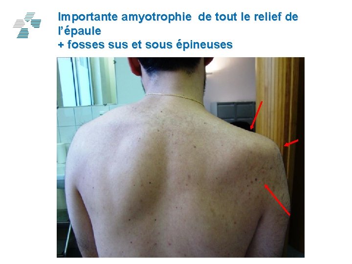 Importante amyotrophie de tout le relief de l’épaule + fosses sus et sous épineuses