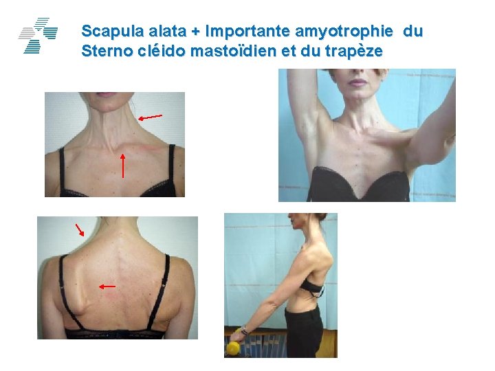 Scapula alata + Importante amyotrophie du Sterno cléido mastoïdien et du trapèze 