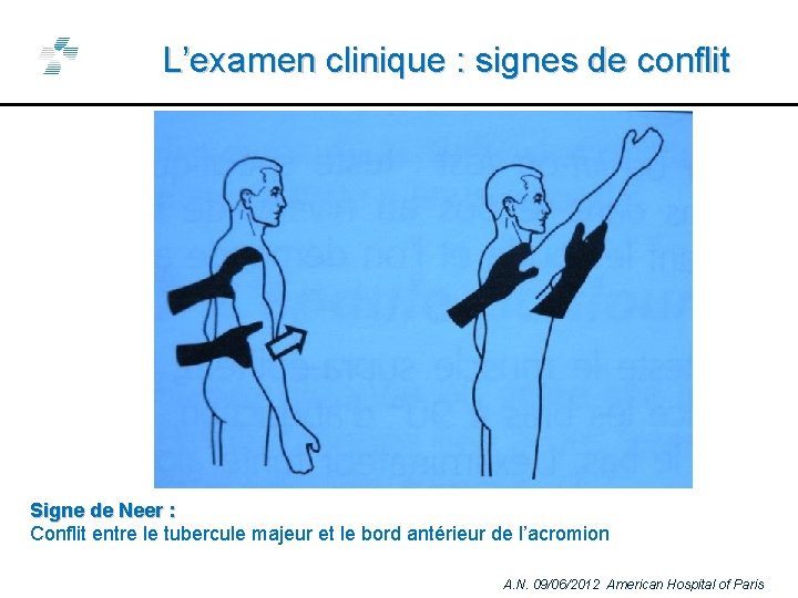 L’examen clinique : signes de conflit Signe de Neer : Conflit entre le tubercule