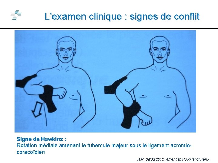 L’examen clinique : signes de conflit Signe de Hawkins : Rotation médiale amenant le