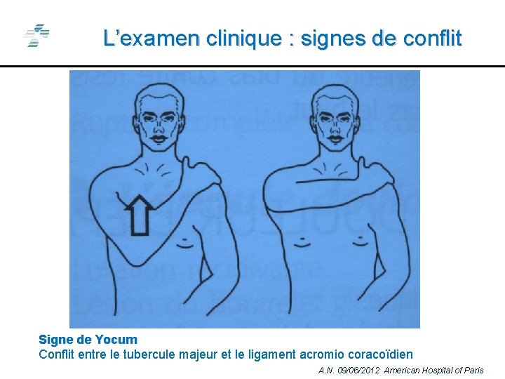 L’examen clinique : signes de conflit Signe de Yocum Conflit entre le tubercule majeur