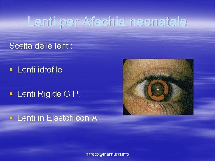 Lenti per Afachia neonatale Scelta delle lenti: § Lenti idrofile § Lenti Rigide G. Lenti per Afachia neonatale Scelta delle lenti: § Lenti idrofile § Lenti Rigide G.
