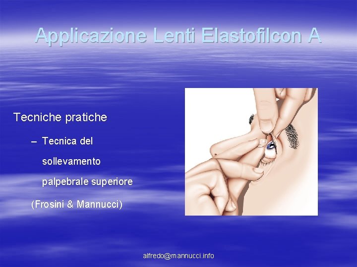 Applicazione Lenti Elastofilcon A Tecniche pratiche – Tecnica del sollevamento palpebrale superiore (Frosini & Applicazione Lenti Elastofilcon A Tecniche pratiche – Tecnica del sollevamento palpebrale superiore (Frosini &